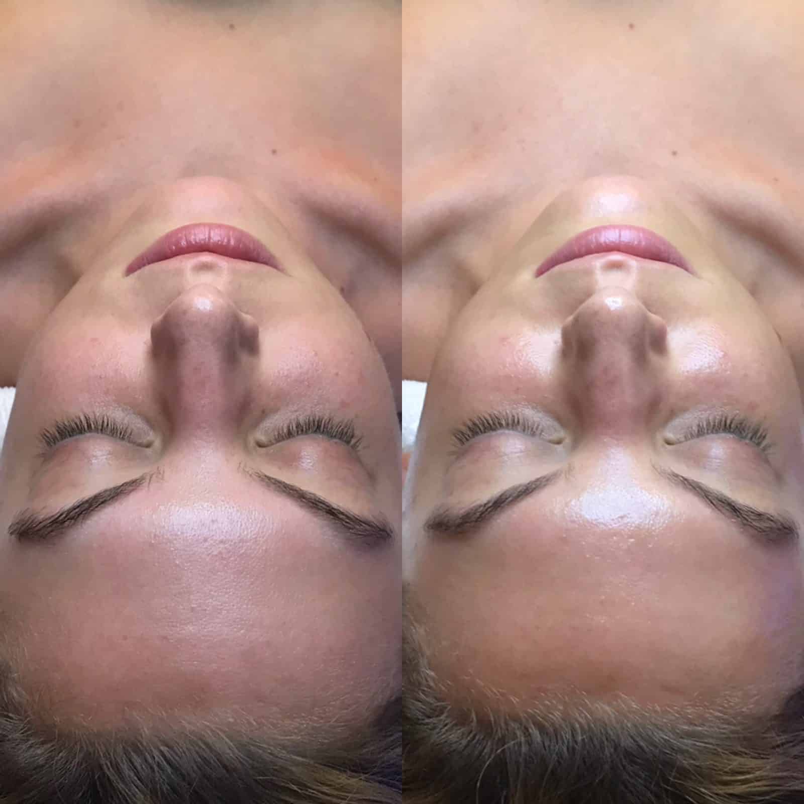 Hydrafacial before and after