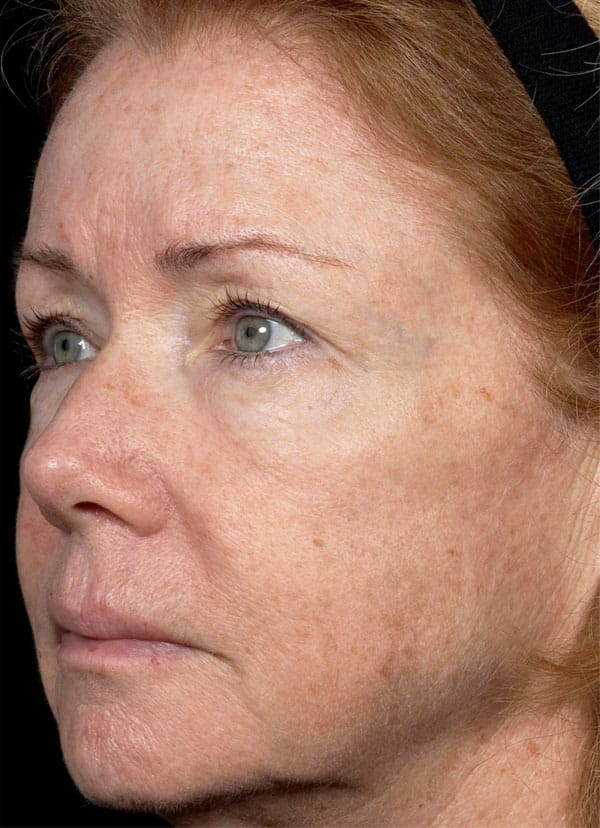 Other Skin Treatments after
