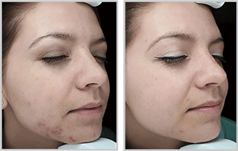 BBL | Kansas City BBL Laser Skin Treatment Experts | Healthylooks