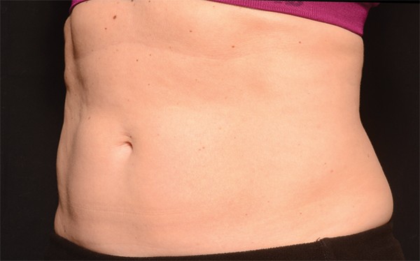 Best CoolSculpting Kansas City