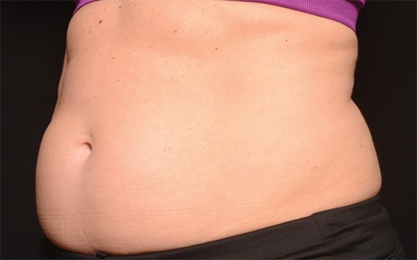 Kansas City Best CoolSculpting