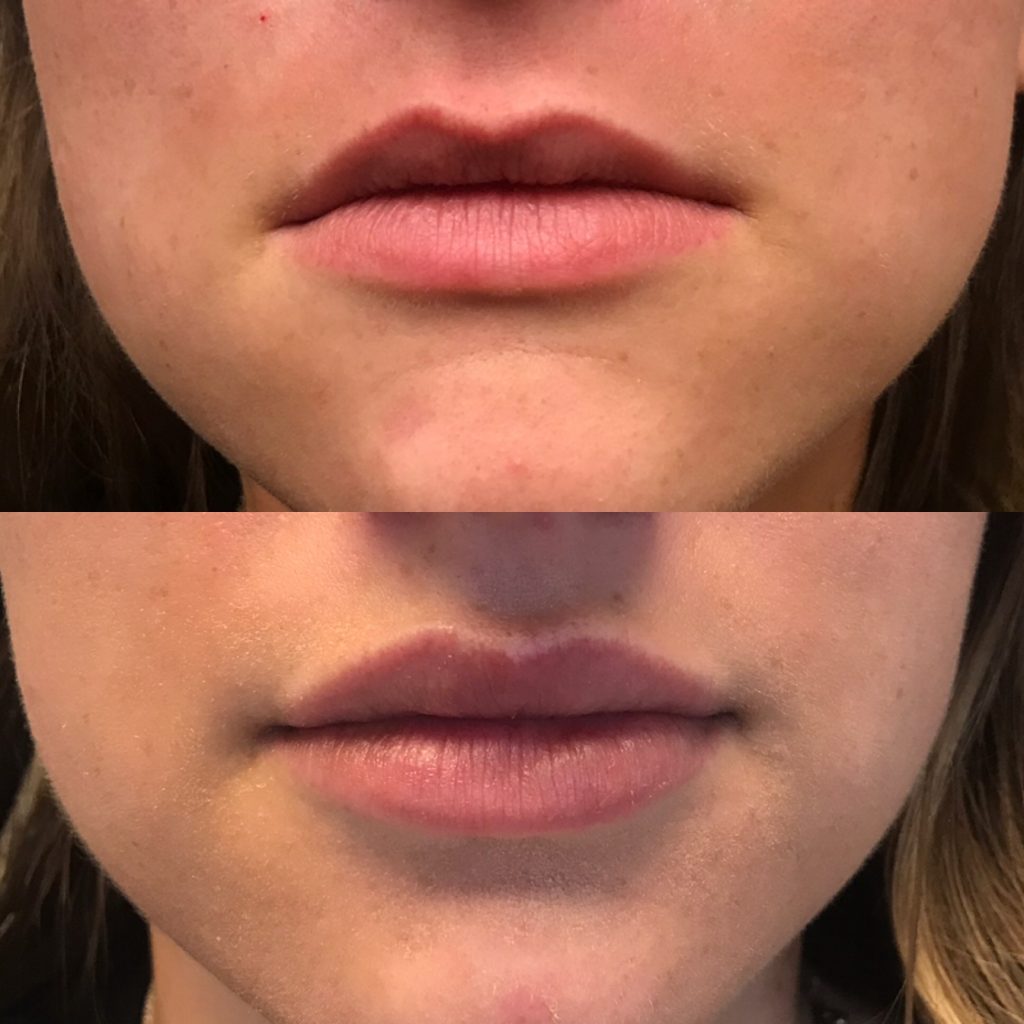 Kansas City lip filler