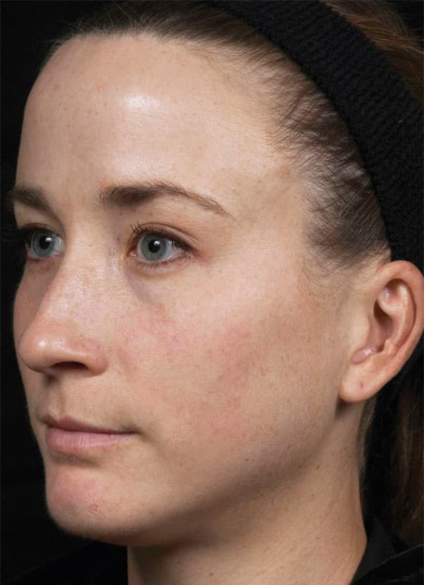fraxel treatment face freckles