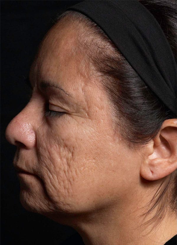 fraxel treatment face scars