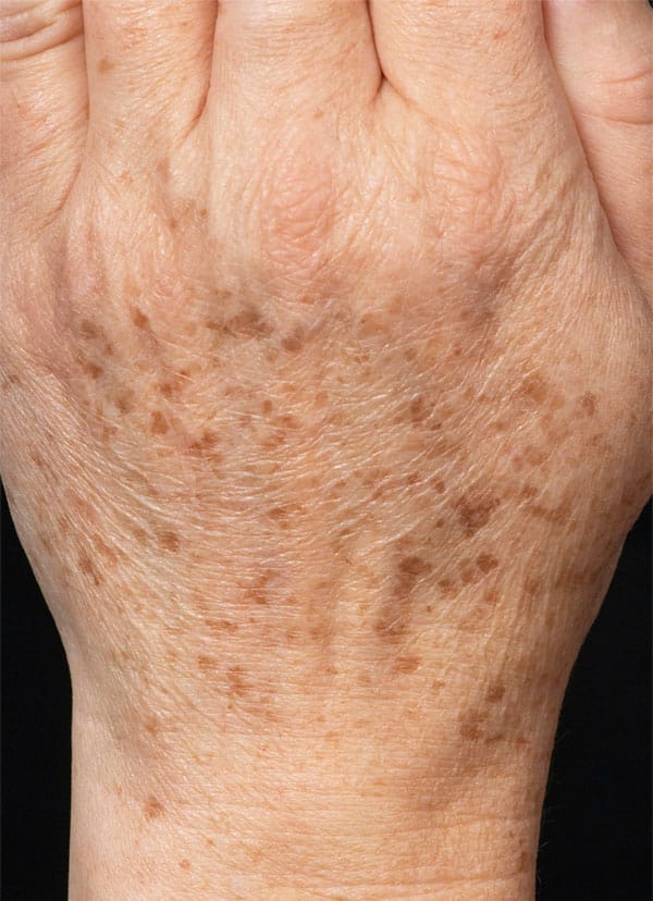 fraxel treatment freckles