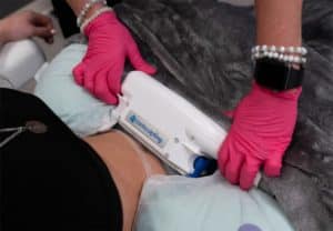 coolsculpting procedure