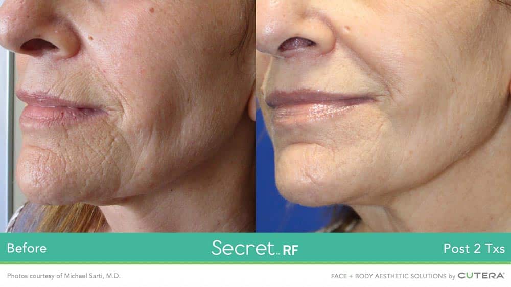 microneedling kansas city