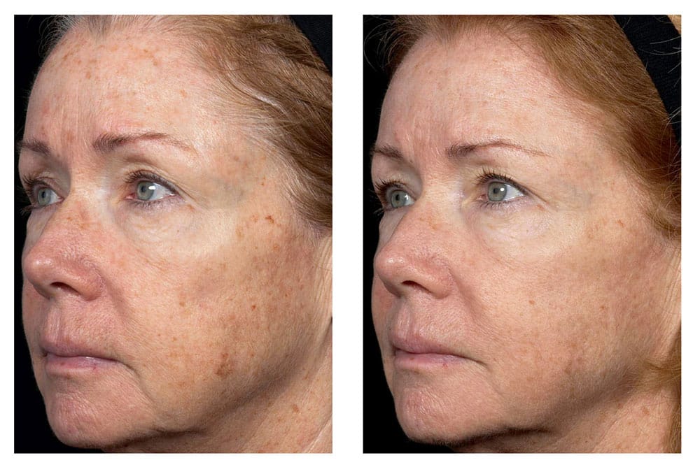 Fraxel laser treatment