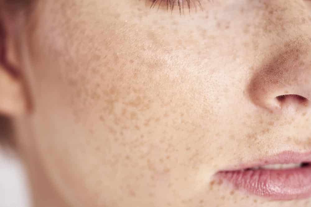 freckles skin treatment kansas city