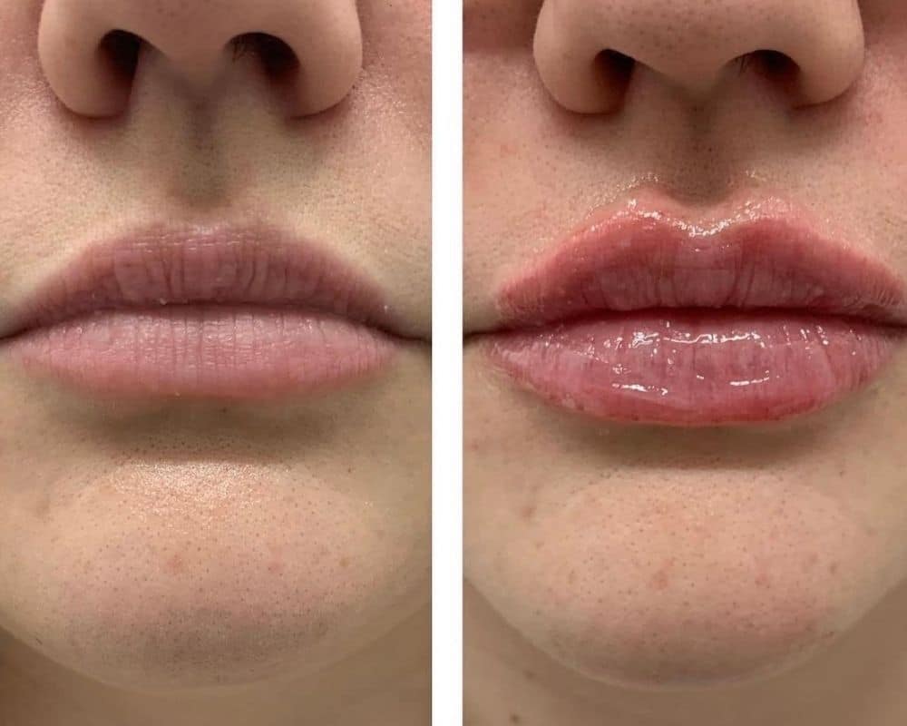 Lip Filler vs Lip Flip