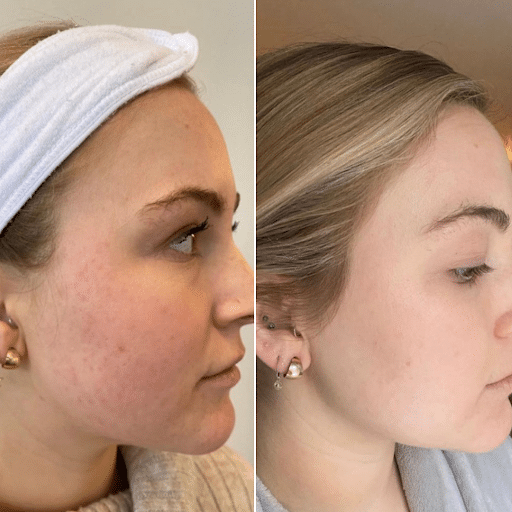 Fall Skin Specials Fraxel VS Perfect Derma Peel