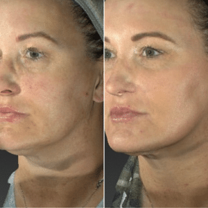 Fall Skin Specials: Fraxel VS Perfect Derma Peel