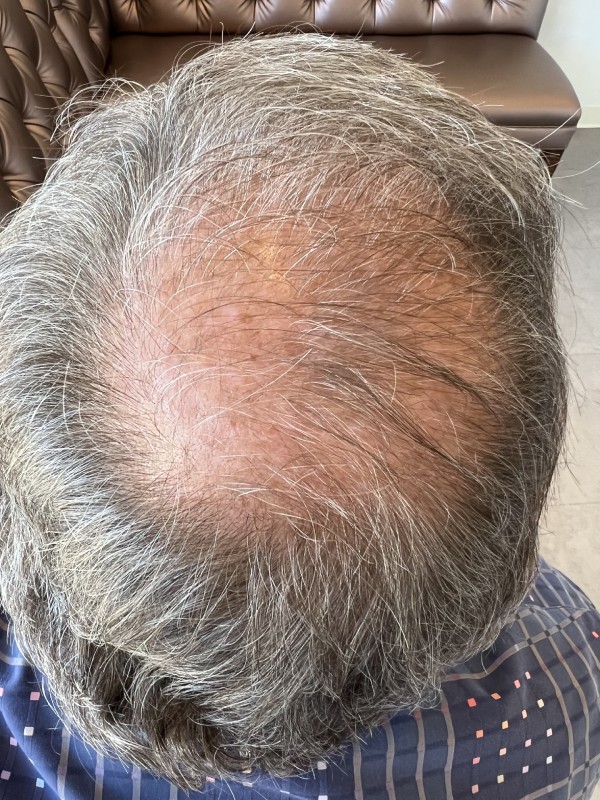 Keravive Scalp Facial Treatment After 45 days