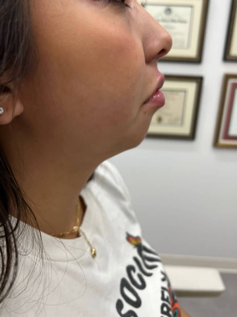 Chin Fillers After 1
