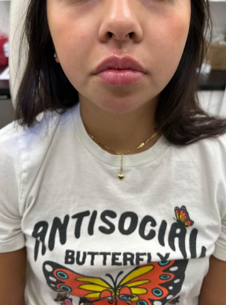 Chin Fillers After 2