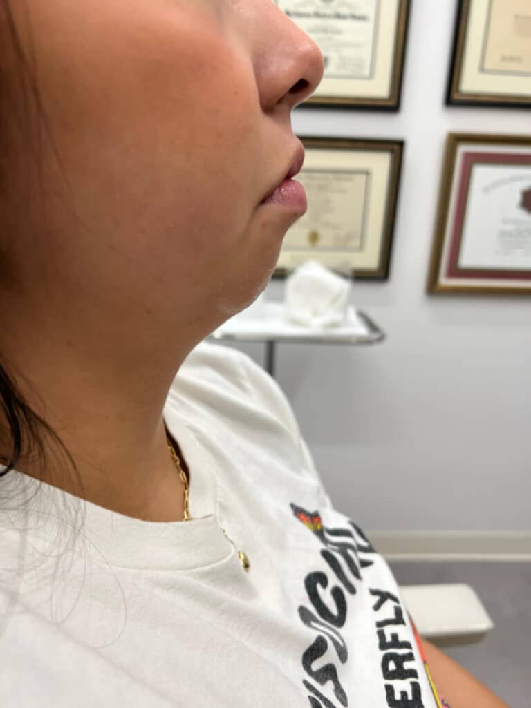 Chin Fillers Before 1
