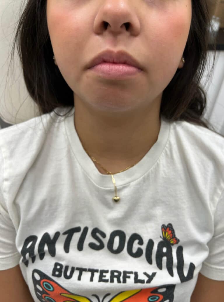Chin Fillers Before 2