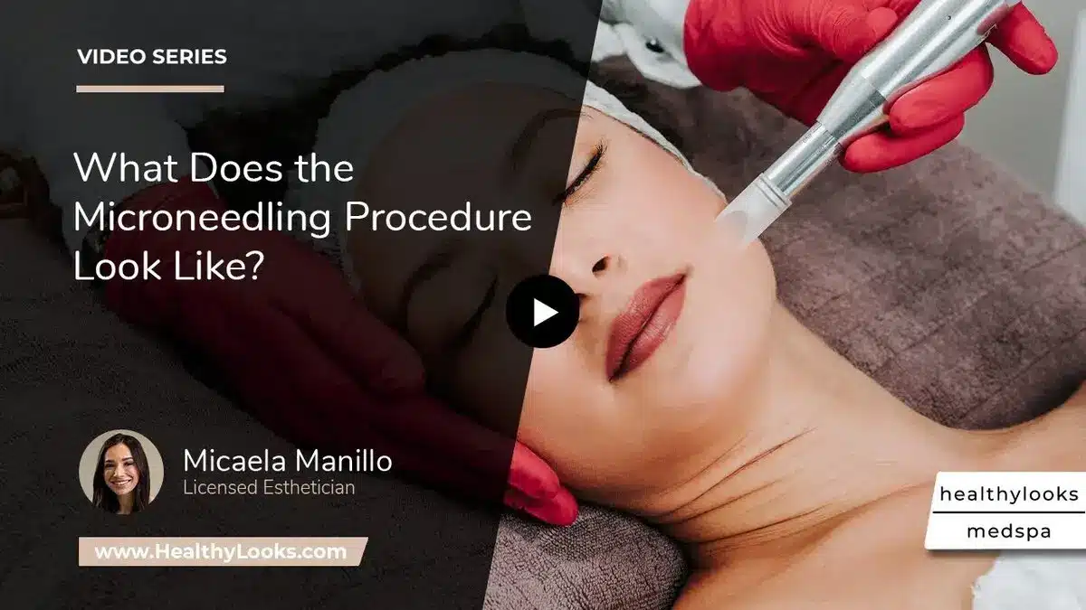 microneedling procedure